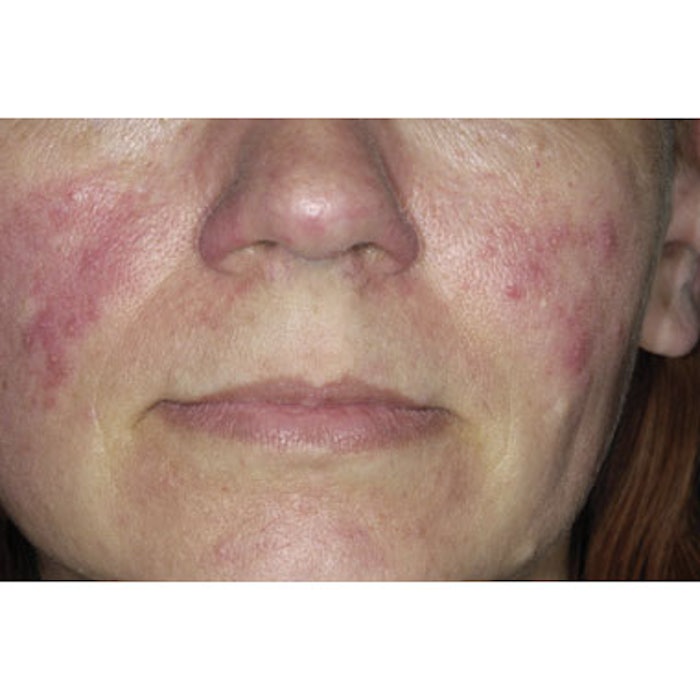 Patient with Rosacea