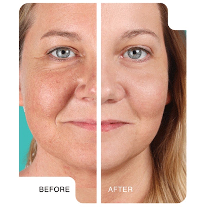 Skin Care Equipment: Meta Therapy by Dermatude