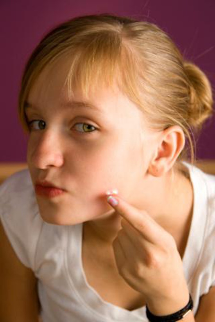 Epiduo Gel Approved For Children As Young As 9 Years Old