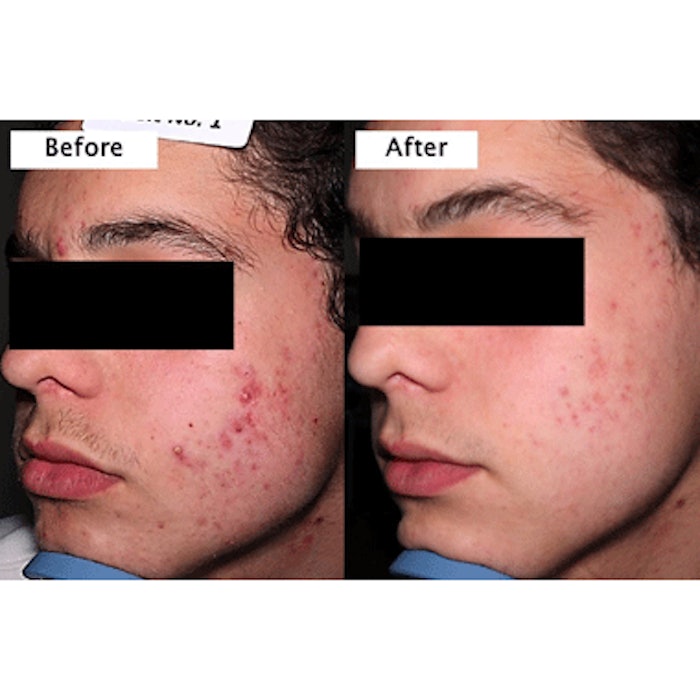 Phase II Results for New Minocycline Topical