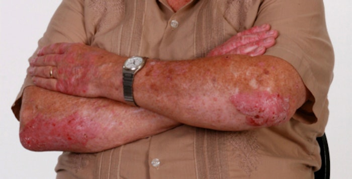 NPF awards six research grants to scientists studying psoriasis and psoriatic arthritis