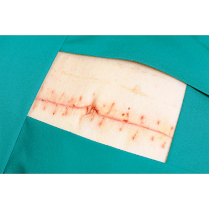 Postoperative Fractional Ablation Reduces Surgical Scars
