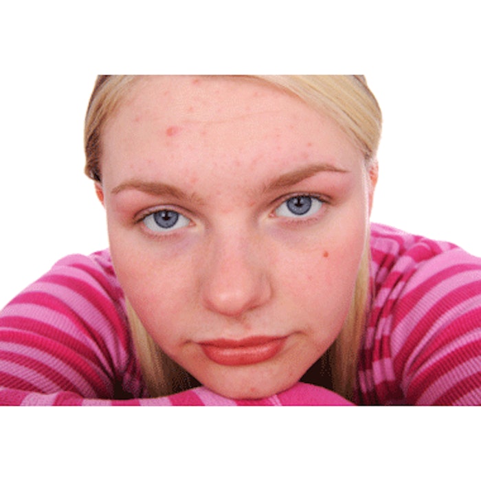 IPL May Reduce Acne Breakouts
