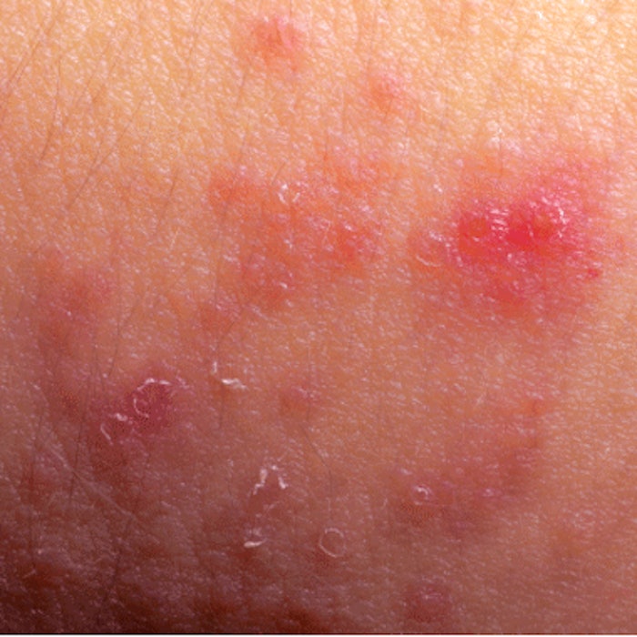 AAD issues new guidelines for the diagnosis of atopic dermatitis