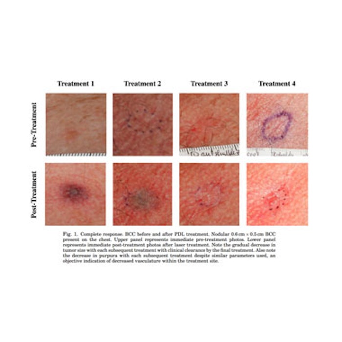 Pulsed dye and Nd:YAG laser for BCC