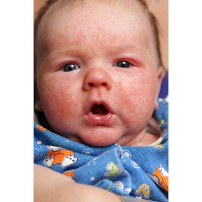 Lipid to Protein Ration Reduced in Eczematous Skin
