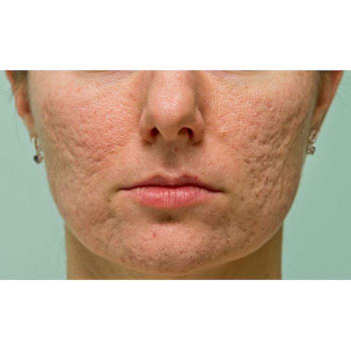 Microneedling Significantly Reduces Acne Scars