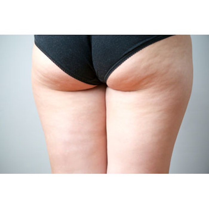 Positive Data From Phase 2a Study Of Injectable Cellulite Treatment