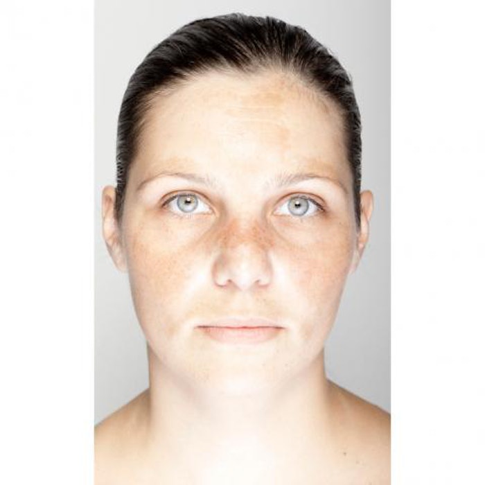 Facial Melasma and Laser Treatments
