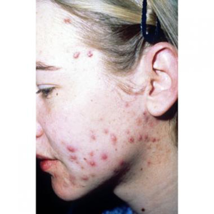 No Meal Required Isotretinoin Capsules on the Market