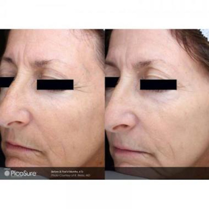 PicoSure Approved to Treat Fine Lines and Wrinkles