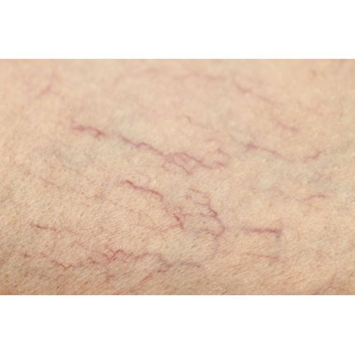 Sclerotherapy for Chest Veins