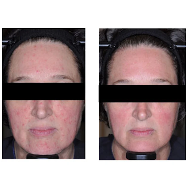 melanotan cured my rosacea How to Get Rid of Permanently Rosacea Treatment in San Diego