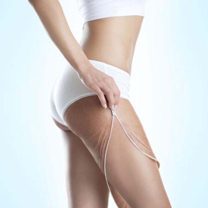 Exilis ELITE FDA-Approved for Cellulite Reduction