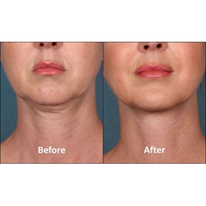 KYBELLA Injectable Approved for Double Chin