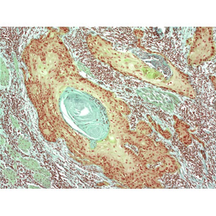 NSAIDs Can Prevent Squamous Cell Carcinoma