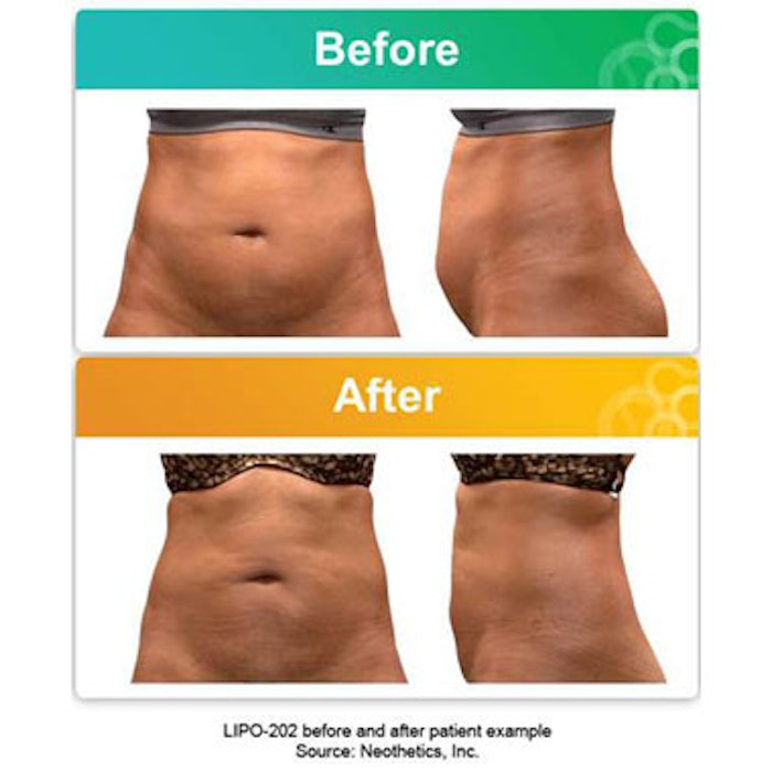 Neothetics Initiates Phase 3 Trials for Abdominal Fat Reducing Injectable