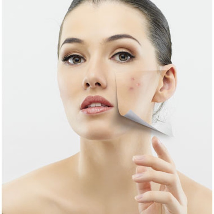 Aesthetics Professionals Team Up With Dating Experts for Acne Awareness