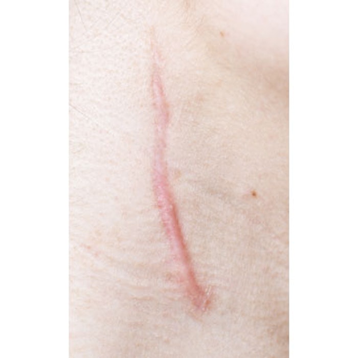 RXI-109 Yields Positive Interim Results After Scar Revision Surgery