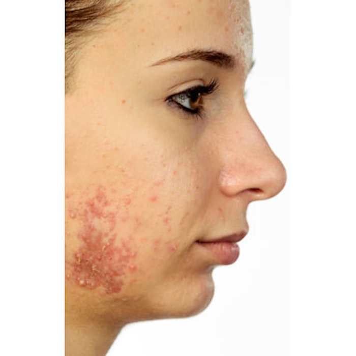 Epiduo Forte Gel Effective for Severe Inflammatory Acne