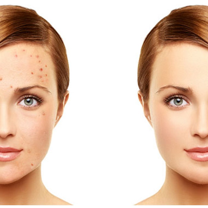 PDT + MAL Option for Severe Acne