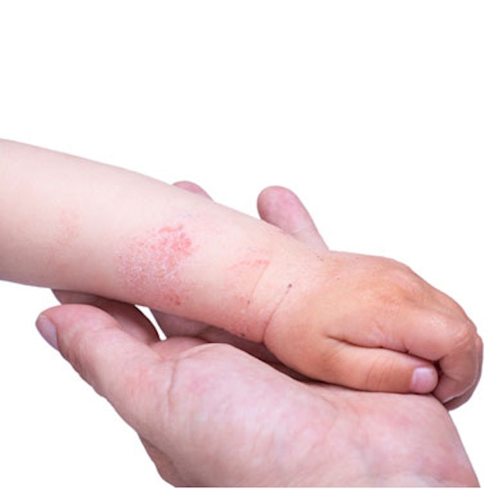 Avène Launches Eczema Awareness Program