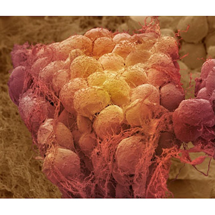 Breakthrough Mesenteric Fat Extraction Performed