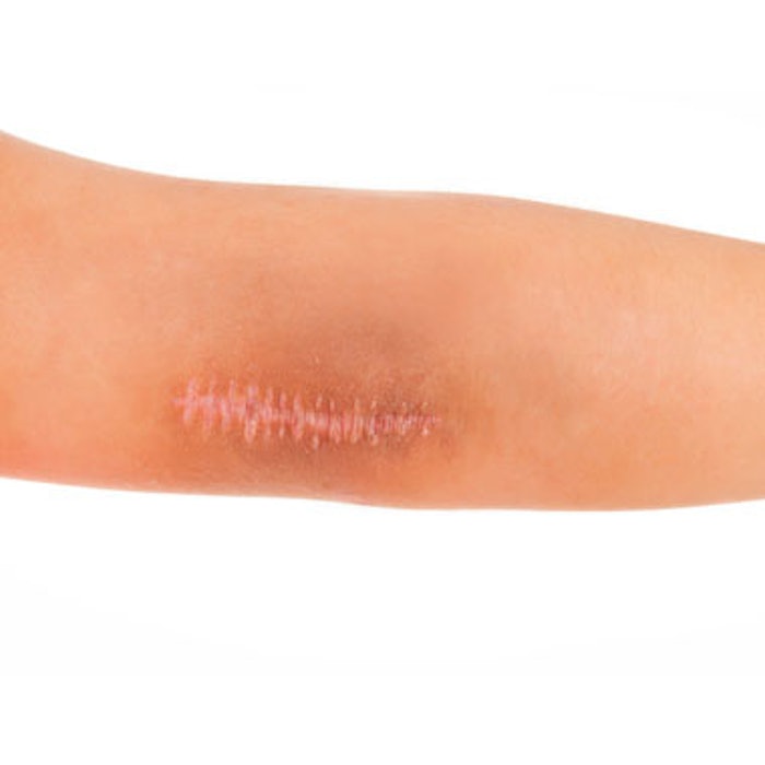 Fractionated Er:YAG More Effective for Scar Revision