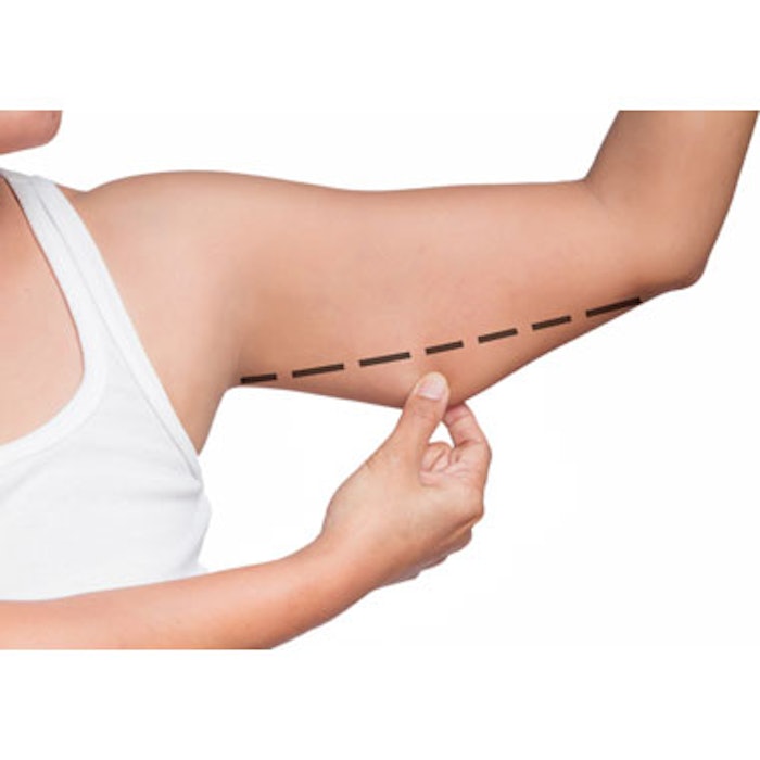 Zeltiq CoolSculpting Cleared To Treat Upper Arm Fat