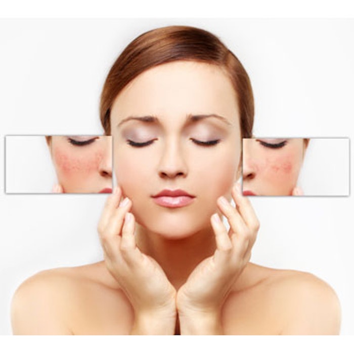RF vs. PDL for Rosacea