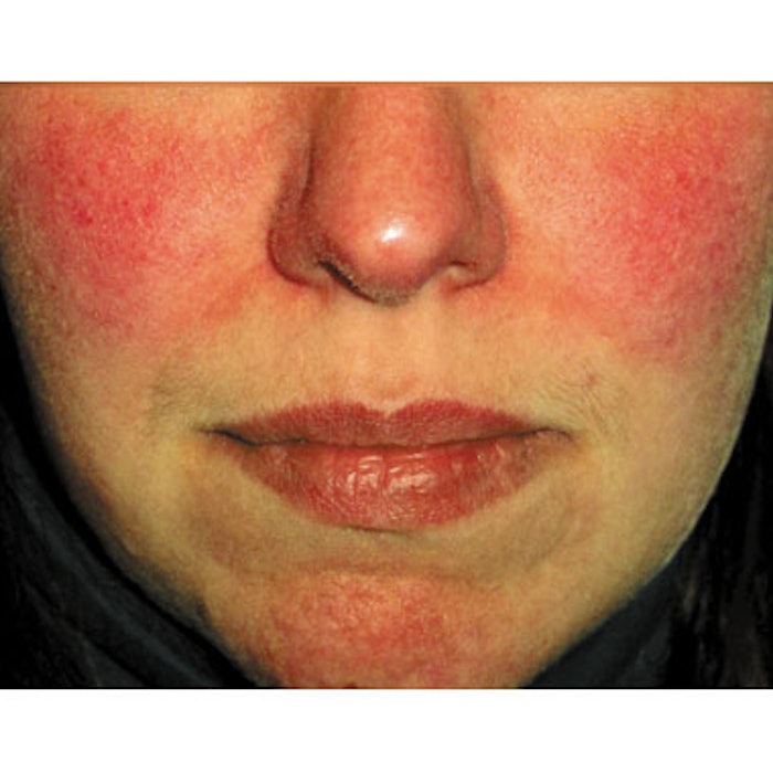Rosacea