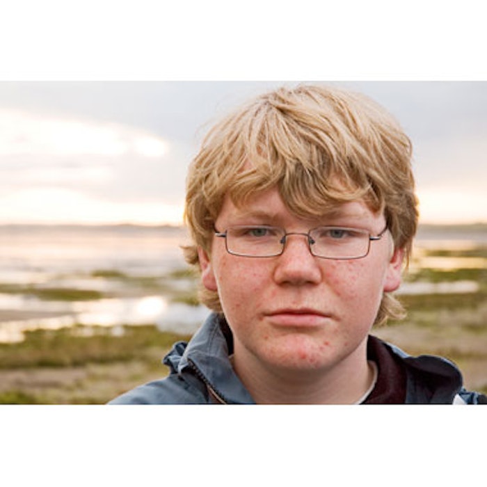Teen with Acne