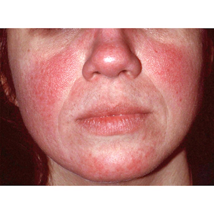 Subtype 1 Facial Redness4web