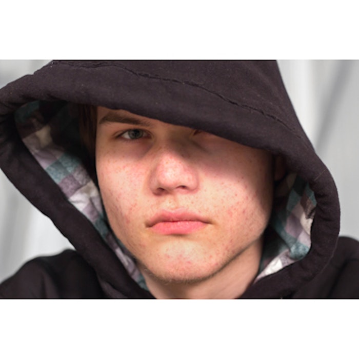 Gettyimages Acne4web