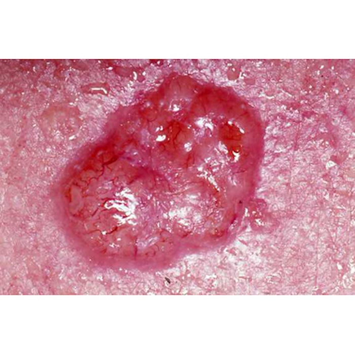 Basal Cell Carcinoma