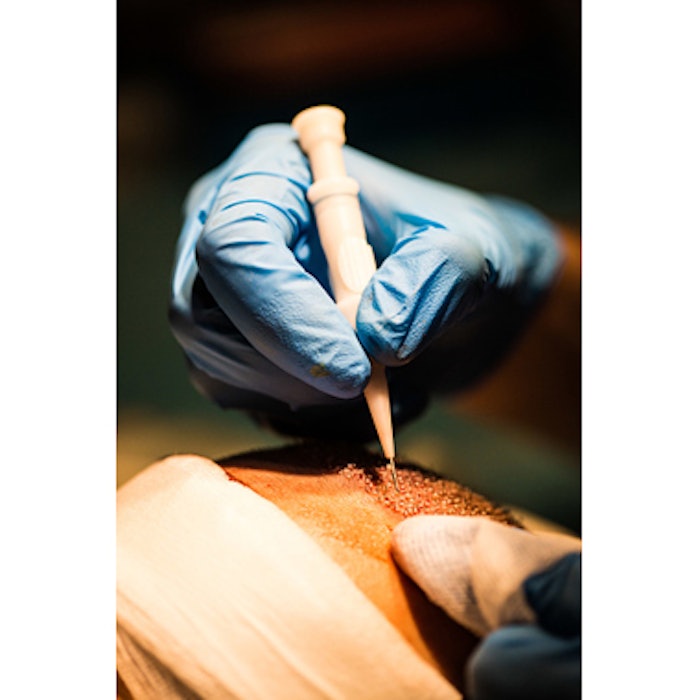 Follicular Unit Extraction