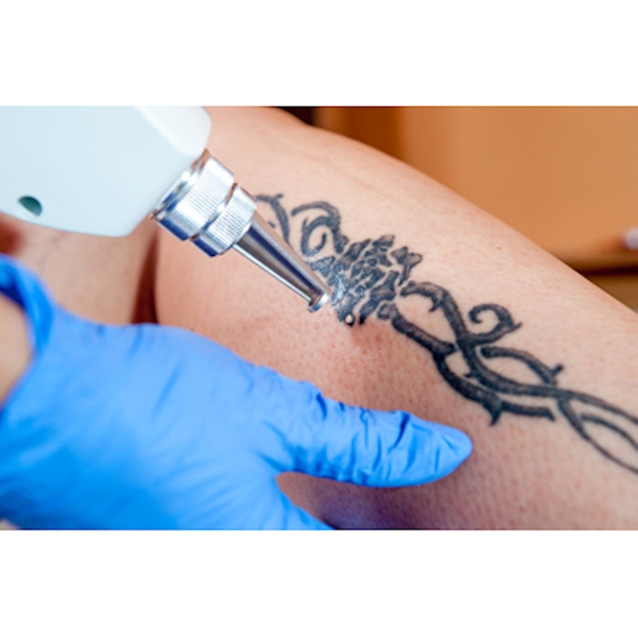 Laser Tattoo Removal