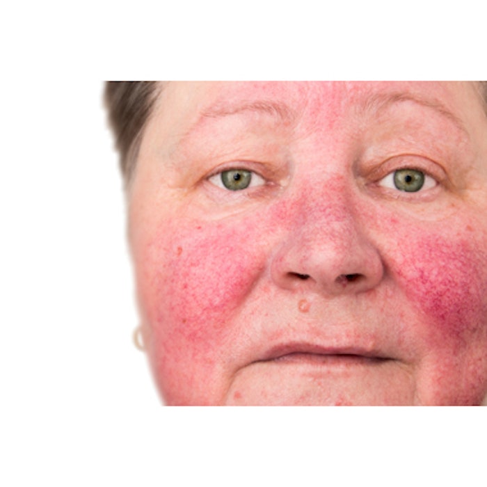 New PDL device more effective for rosacea