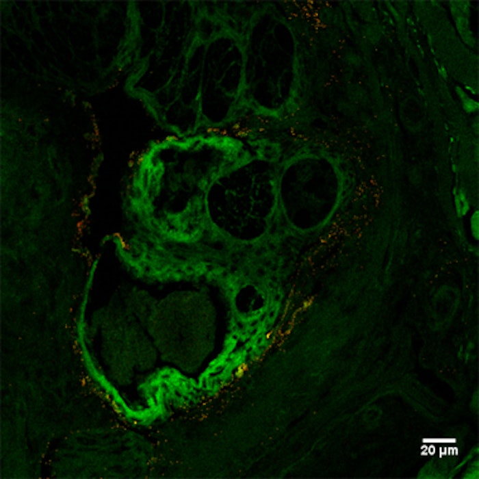 Sebacia micropartociles in seat glands
