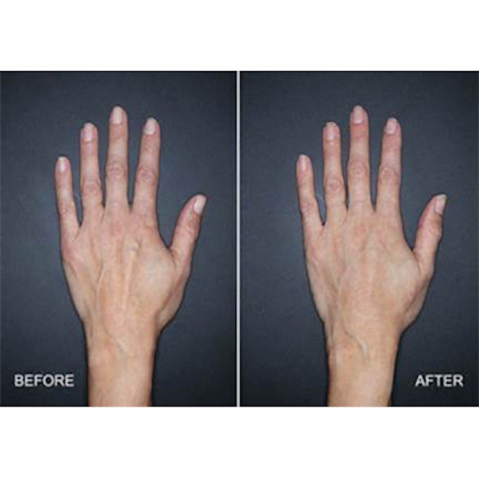 Four weeks after treatment with 3mL of Restylane Lyft