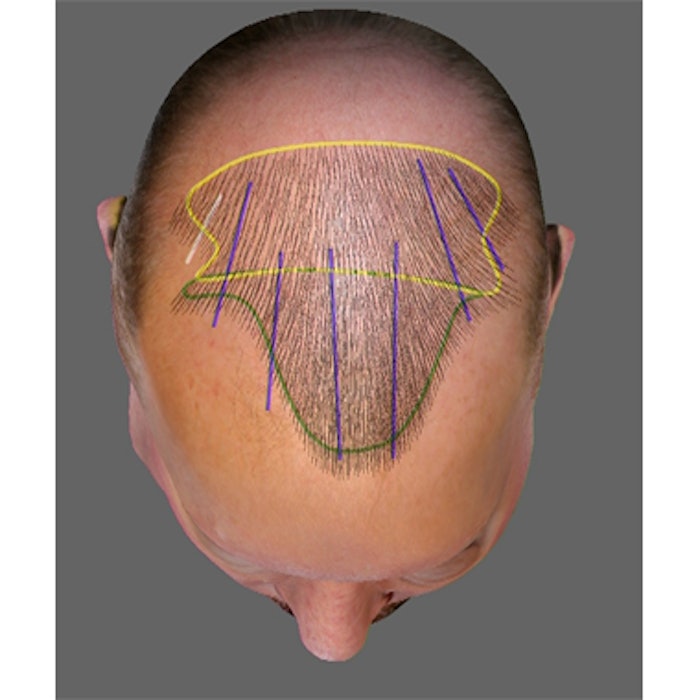 ARTAS Hair Studio Application