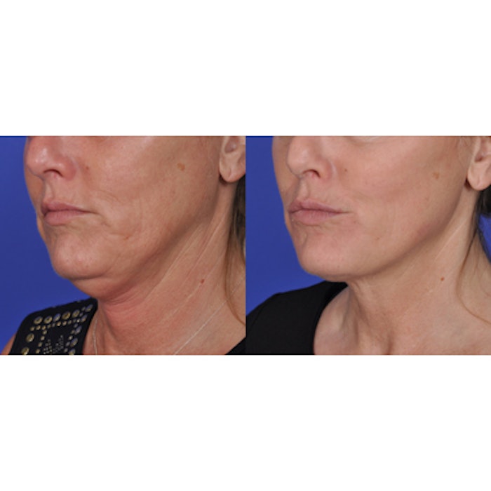 Before and one month after ThermiTight treatment