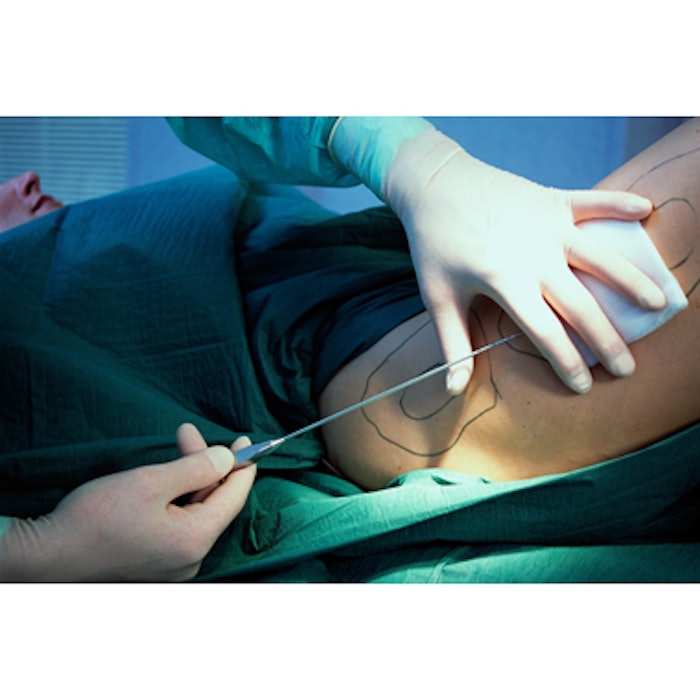 Liposuction procedure