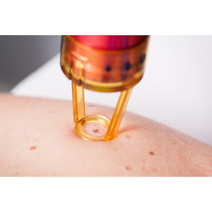Double-pulse Technique For Pigmented Lesions