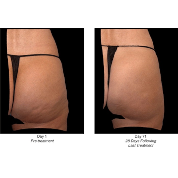 Before and After CCH for Cellulite