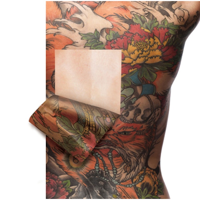 Tattoo Removal | MedEsthetics