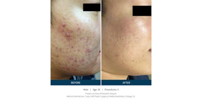 Bellus Medical offers a full product line built to deliver skin rejuvenation and restoration to your patients – and your bottom line. Interested in adding one of our proven innovations to your practice? Learn more here!