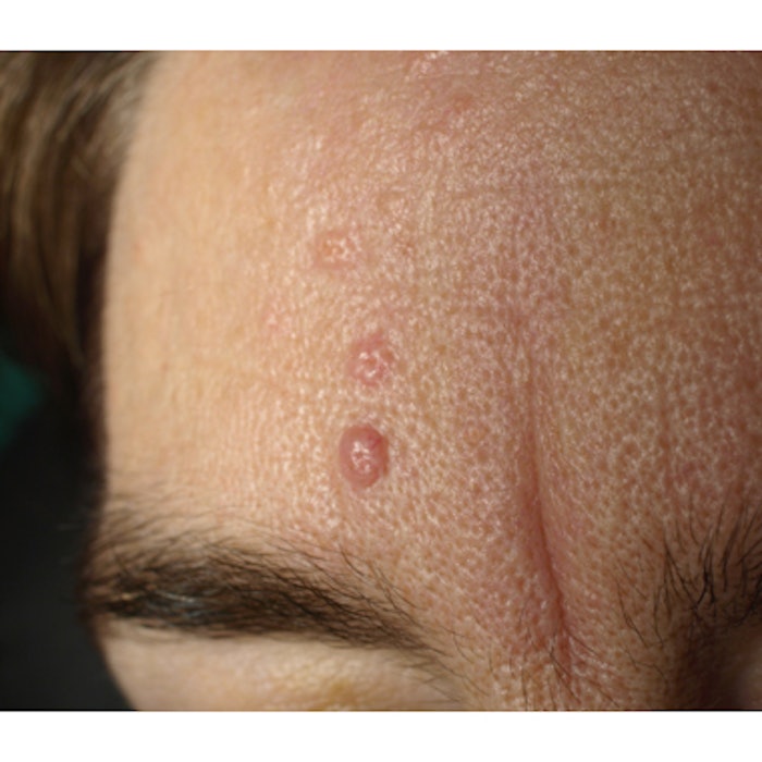 Sebaceous Hyperplasia