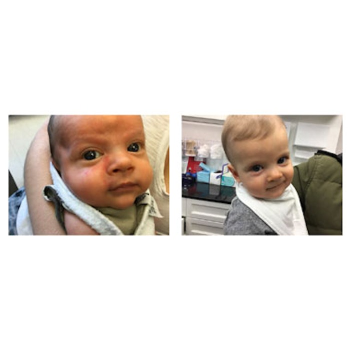 Before and after treatment with Vbeam pulsed dye laser