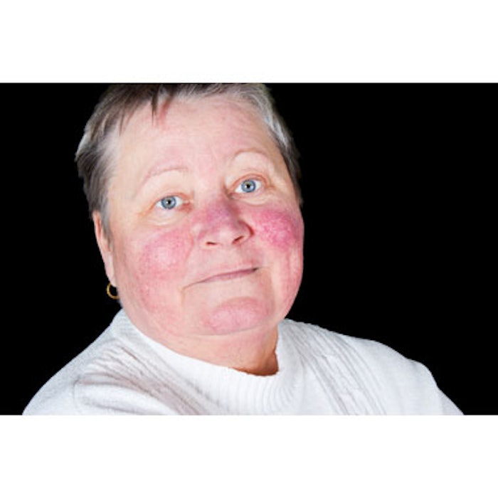 Woman With Rosacea